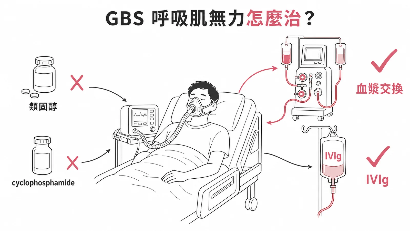 GBS呼吸肌無力首選治療：血漿交換與IVIg對比錯誤選項的示意圖
