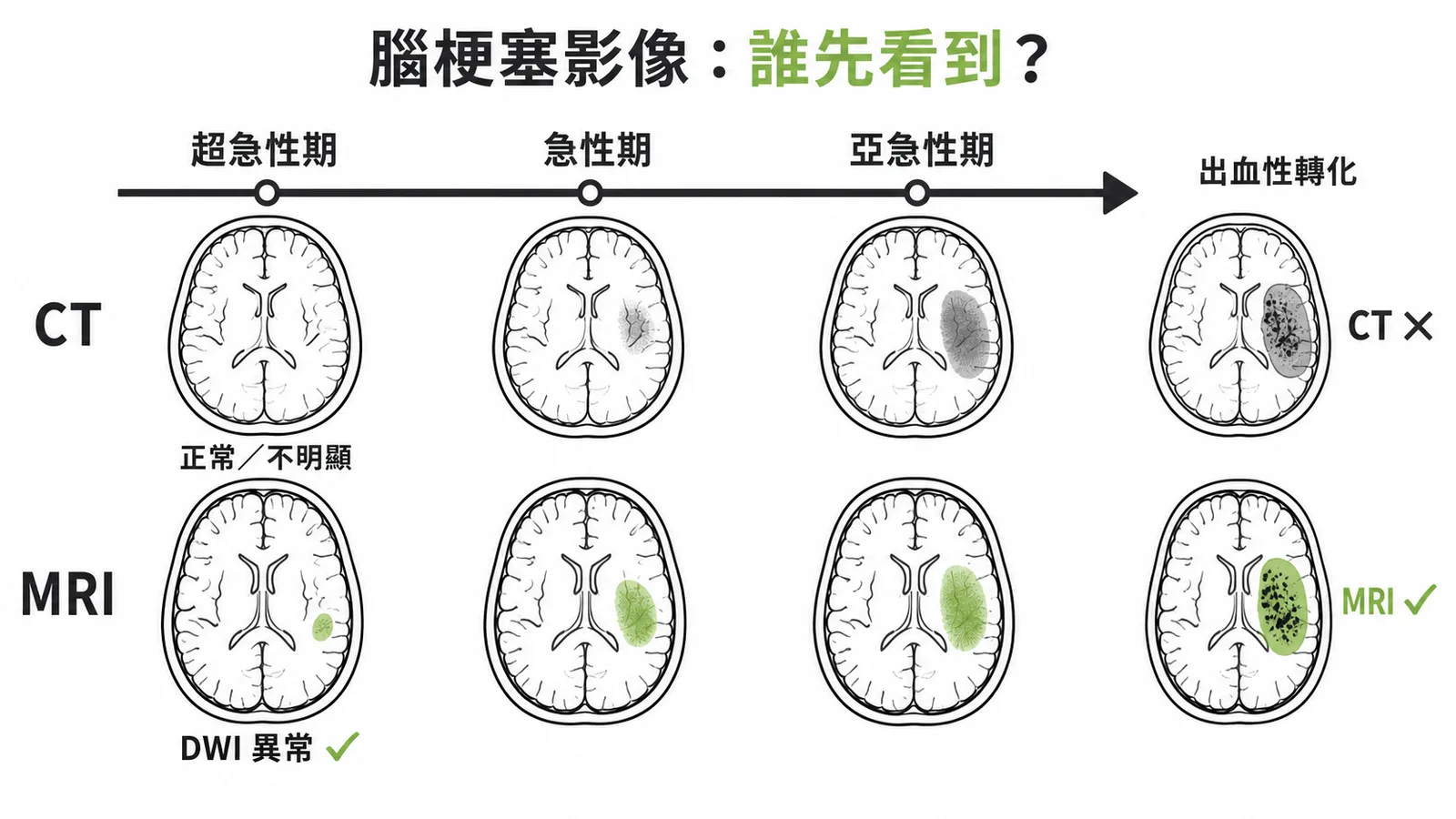 腦梗塞影像時間軸：MRI的DWI在超急性期即可偵測，對出血性轉化也比CT更敏感
