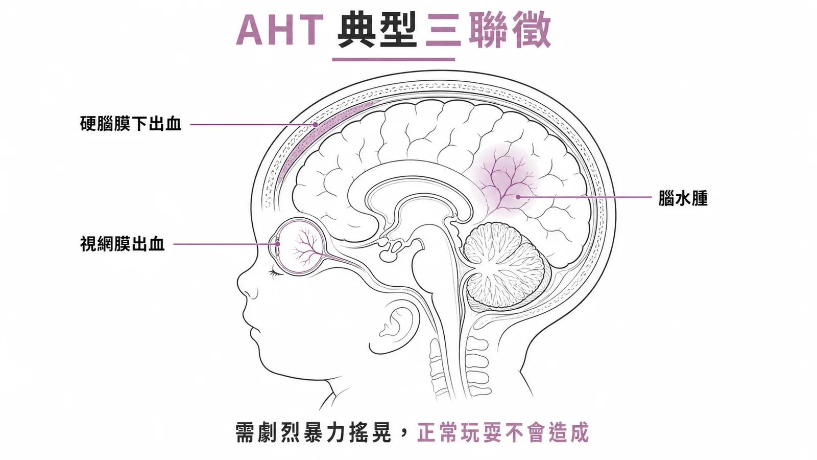 受虐性腦傷典型三聯徵：硬腦膜下出血、視網膜出血、腦水腫