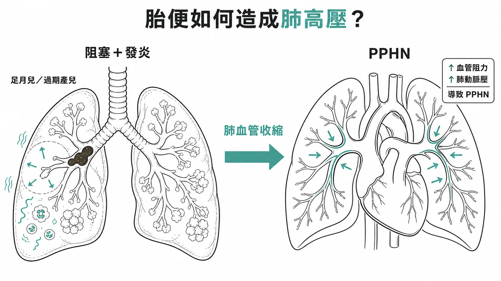 胎便吸入後引發肺血管收縮導致新生兒持續性肺高壓的機轉
