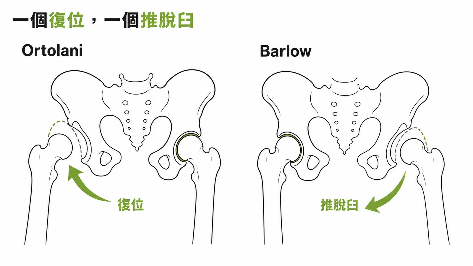 Ortolani是復位已脫臼髖關節而Barlow是推脫臼不穩定髖關節