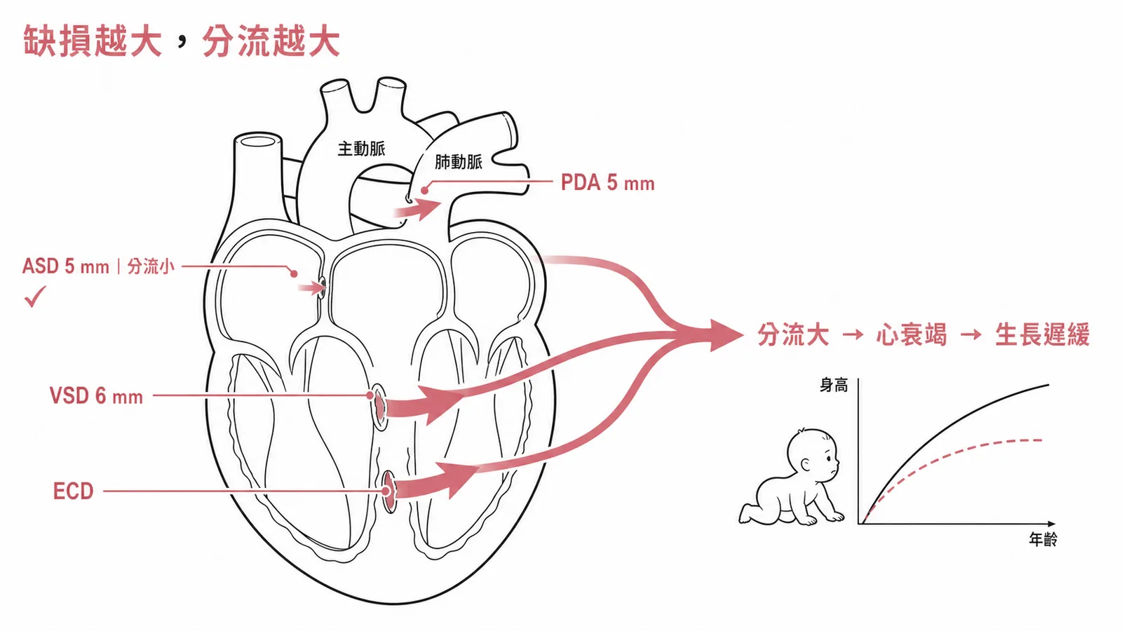 心臟缺損越大分流越大越容易心衰竭導致嬰兒生長遲緩