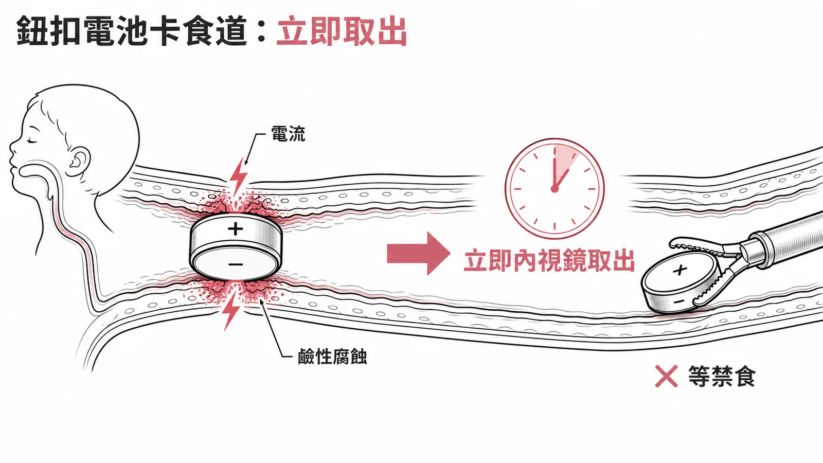 鈕扣電池卡食道產生電流鹼性腐蝕必須立即內視鏡取出