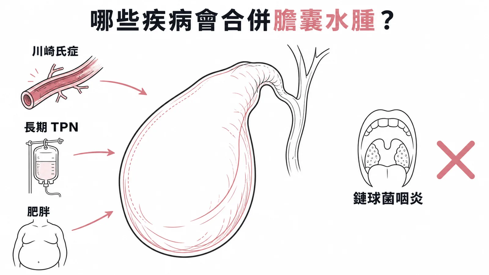 川崎氏症長期TPN肥胖可合併膽囊水腫但鏈球菌咽炎不會