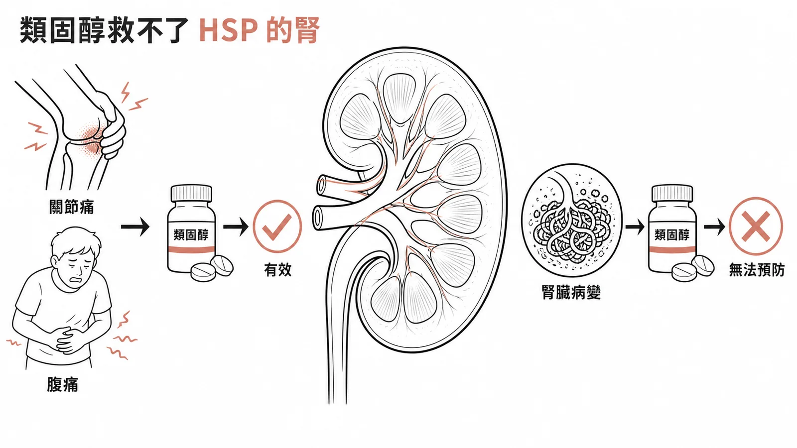 類固醇對HSP的關節痛腹痛有效，但無法預防腎臟病變