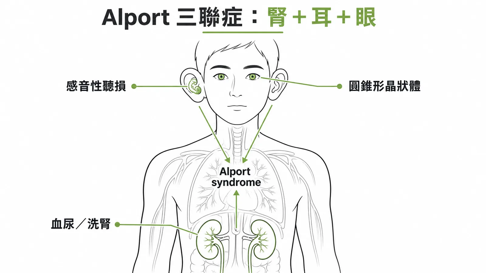 Alport syndrome三聯症：腎臟血尿、感音性聽損、圓錐形晶狀體
