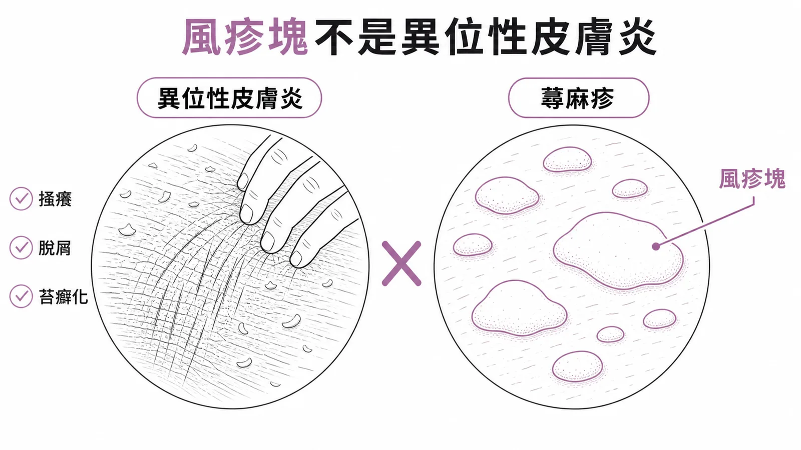風疹塊屬蕁麻疹特徵,不是異位性皮膚炎的典型表現