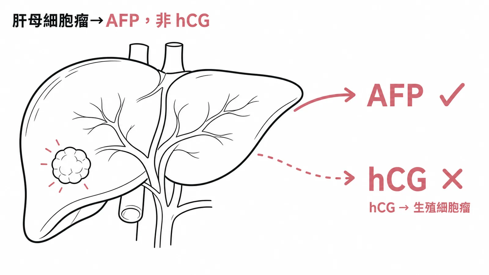 肝母細胞瘤的腫瘤標記是AFP而非hCG，hCG屬生殖細胞瘤