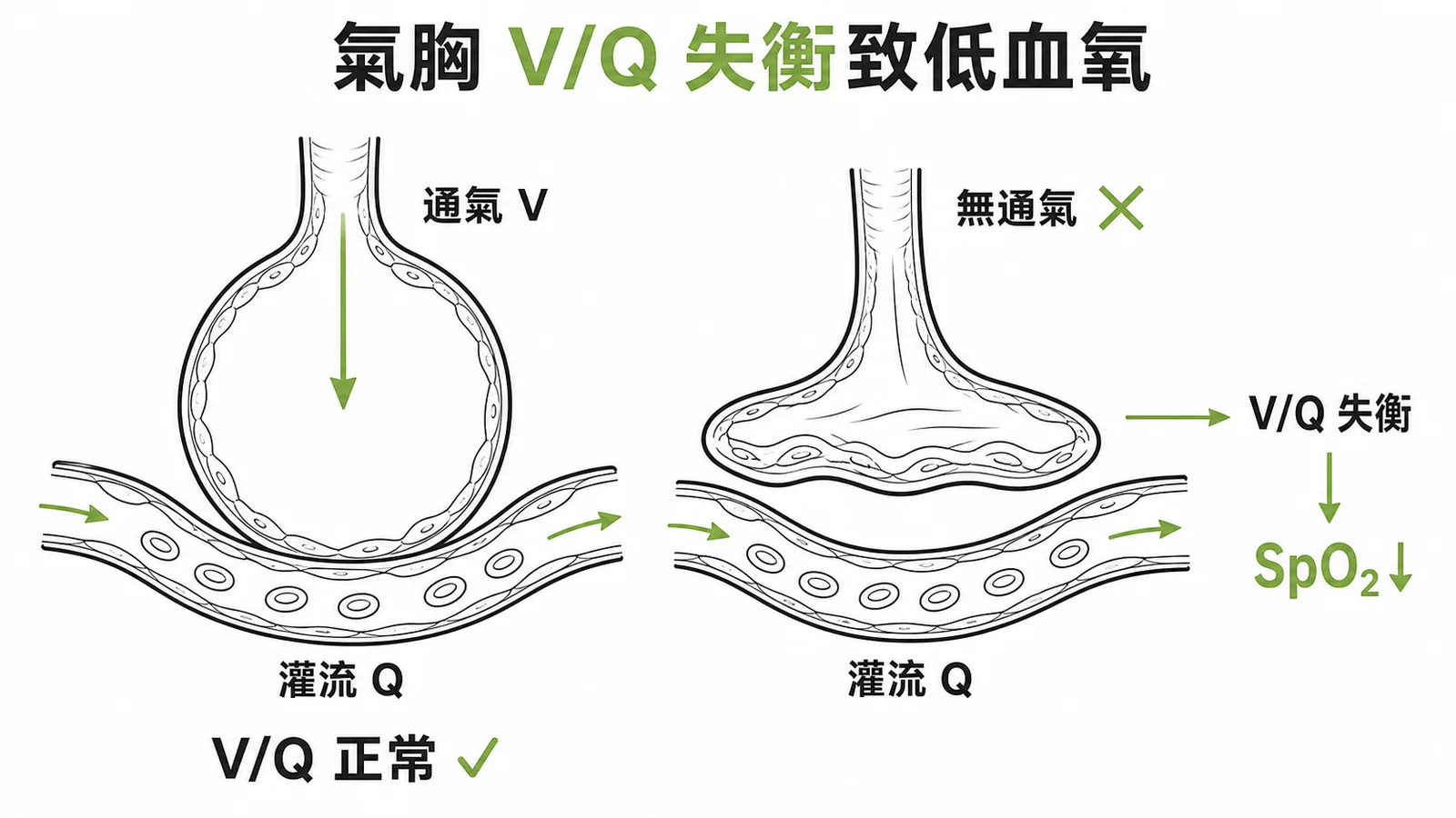 氣胸造成V/Q失衡導致低血氧的肺泡對比示意圖