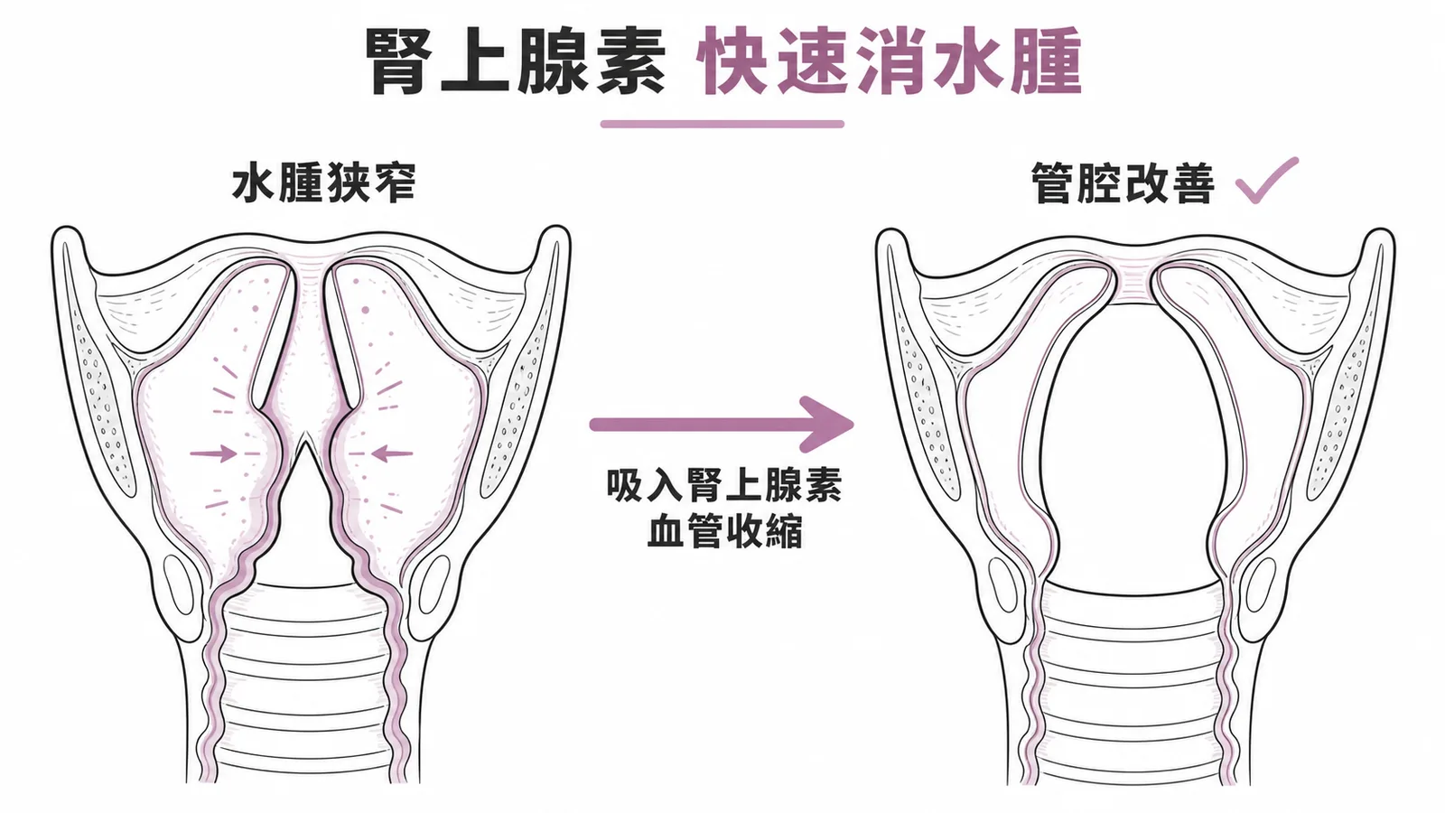 吸入腎上腺素使喉部水腫消退、管腔改善的對比示意圖