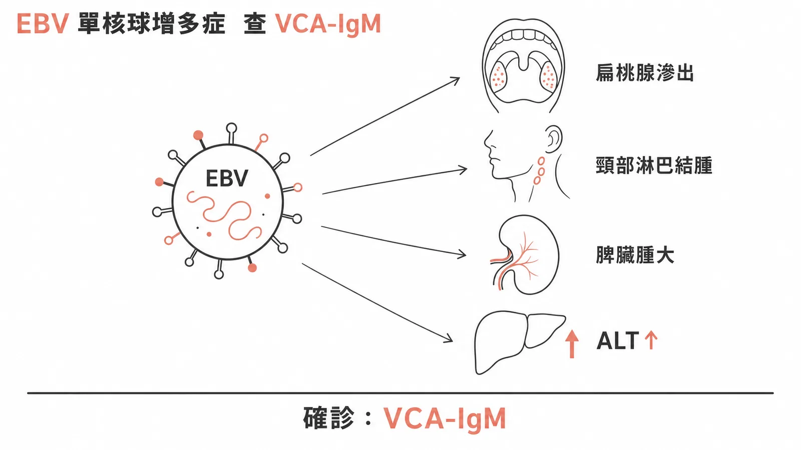EBV傳染性單核球增多症典型表現與VCA-IgM確診示意圖