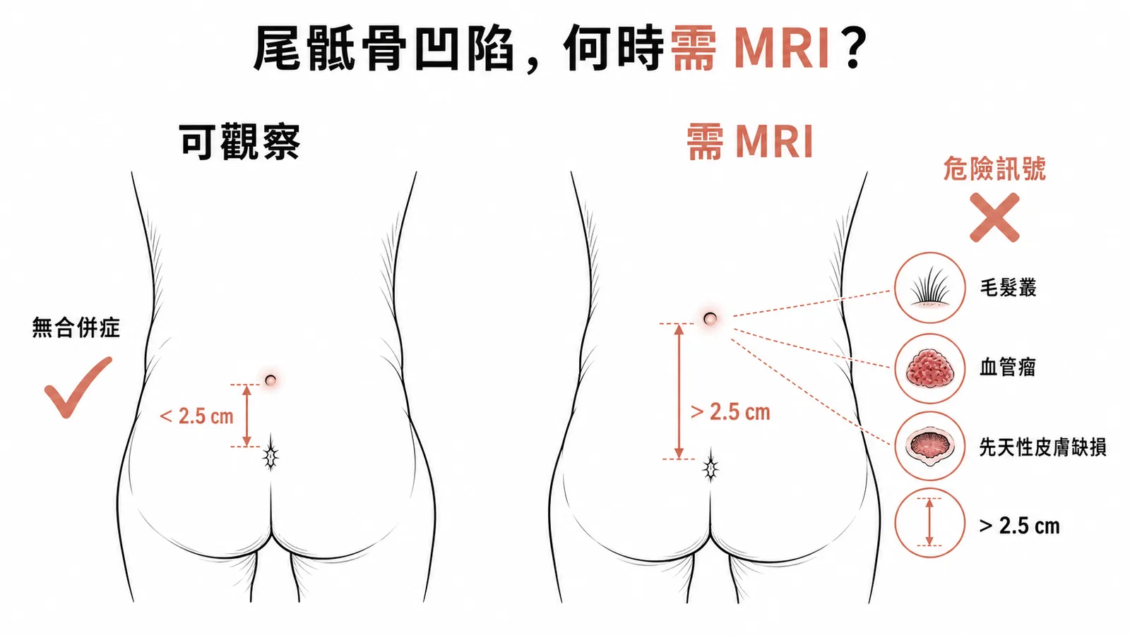 尾骶骨凹陷良性可觀察與需MRI危險訊號的對比示意圖