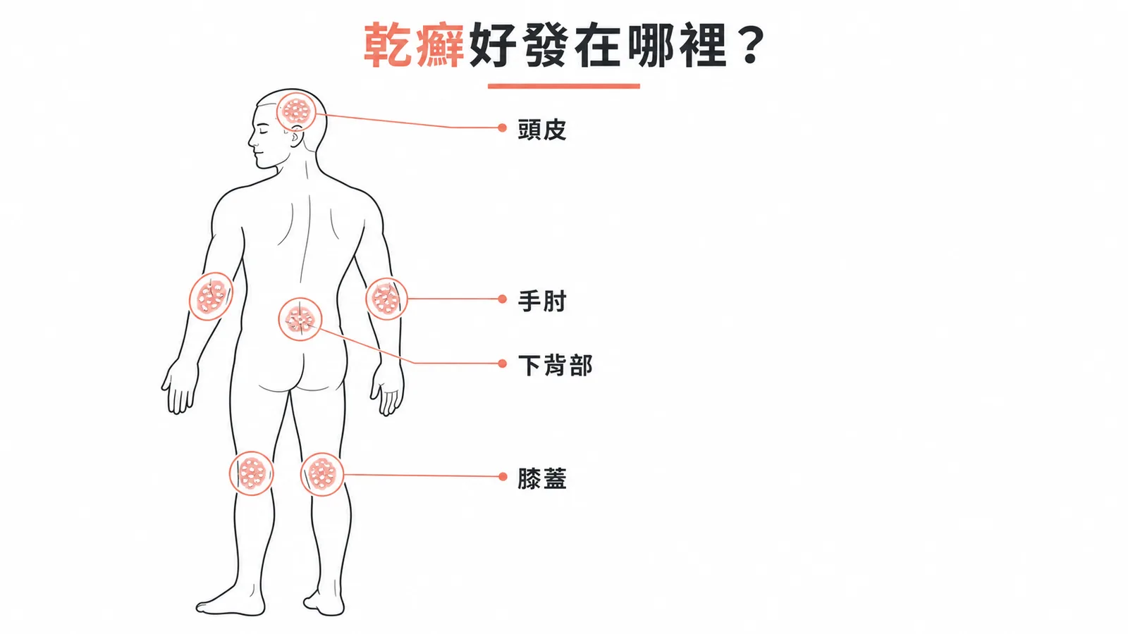 乾癬好發部位示意圖:頭皮、手肘、膝蓋、下背部