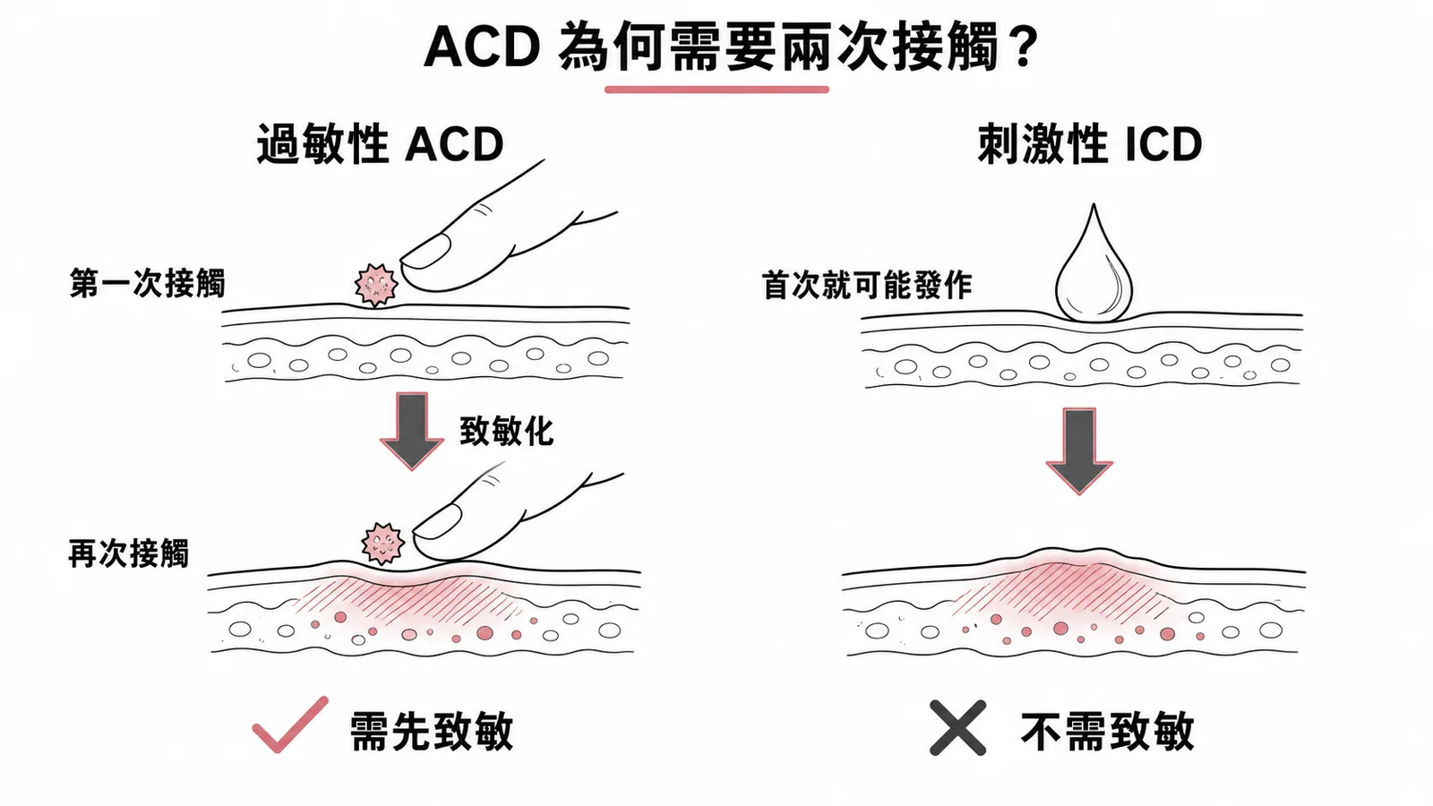 過敏性接觸性皮膚炎需兩次接觸致敏vs刺激性首次即發