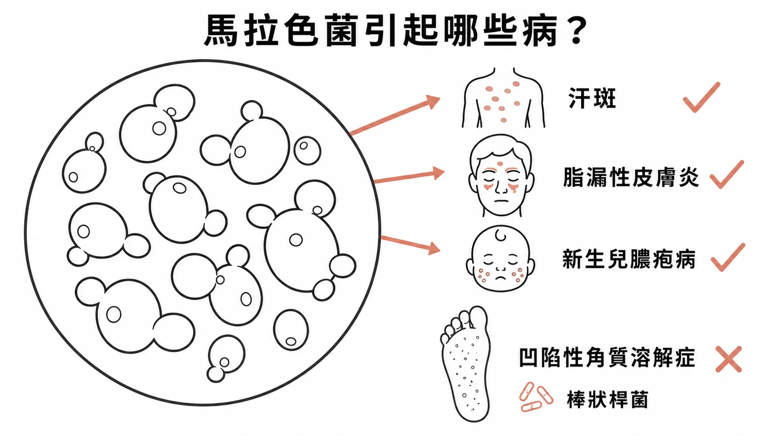 馬拉色菌引起汗斑脂漏性皮膚炎新生兒膿疱病但非凹陷性角質溶解症