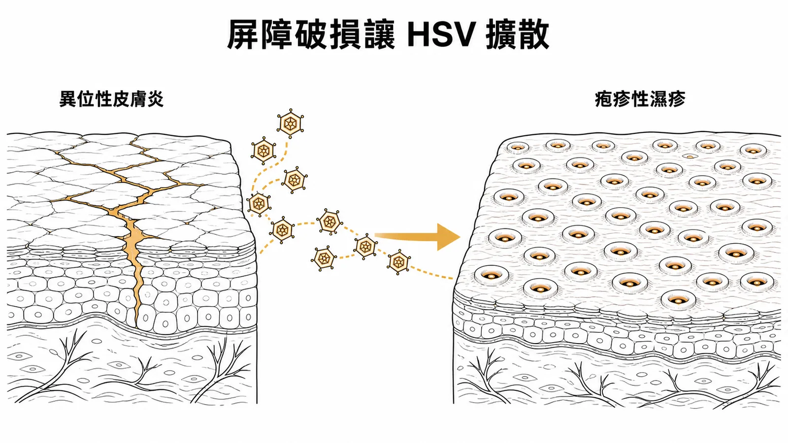 異位性皮膚炎屏障破損讓HSV擴散形成疱疹性濕疹
