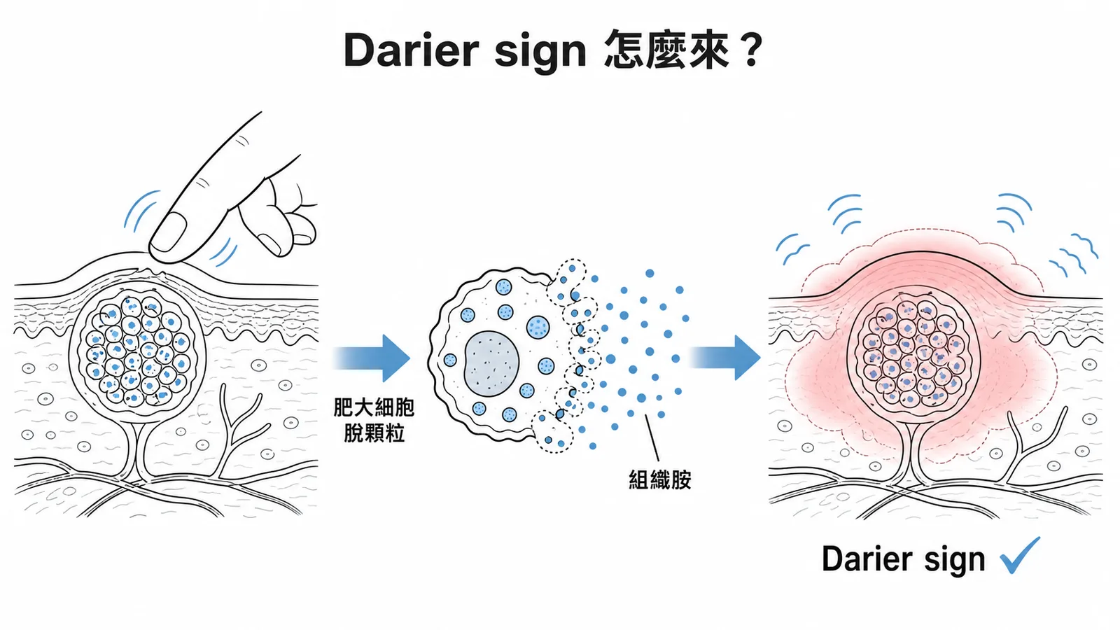 Darier sign機轉：搔抓肥大細胞瘤→脫顆粒→組織胺→蕁麻疹反應