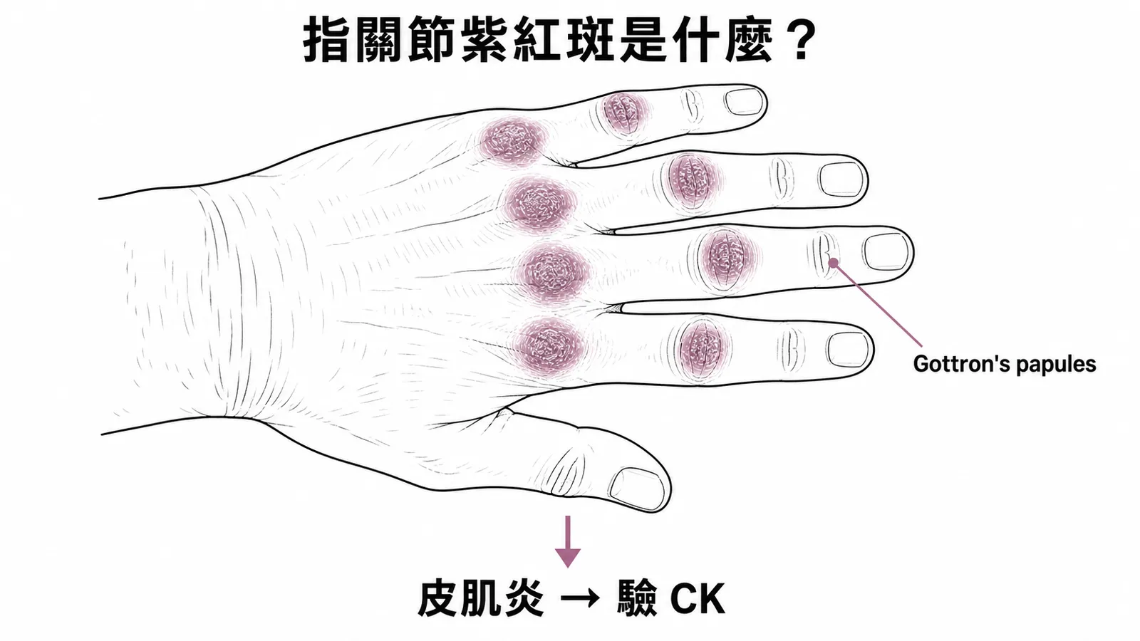 手指關節Gottron papules指向皮肌炎最重要驗CK
