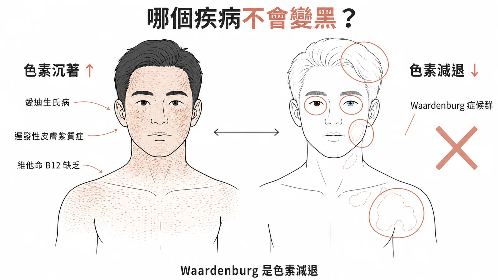 色素沉著與色素減退疾病對照:Waardenburg症候群為色素減退不會變黑