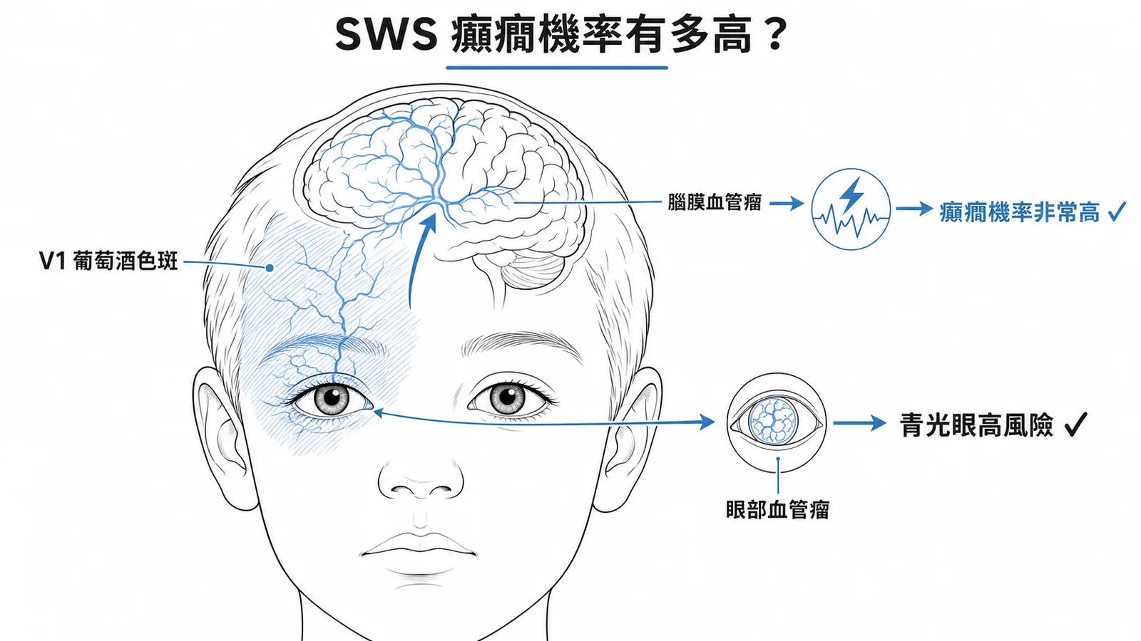 Sturge-Weber症候群三大侵犯區域：V1葡萄酒色斑、腦膜血管瘤致癲癇、眼部血管瘤致青光眼