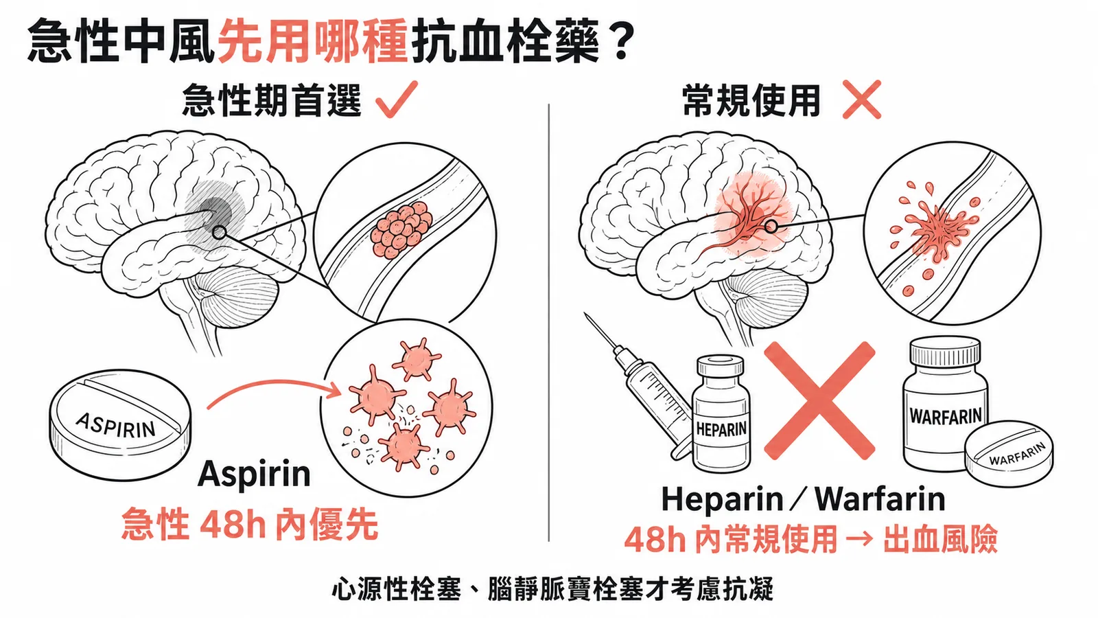 急性缺血性中風抗血栓藥物選擇:先用抗血小板而非常規抗凝血劑
