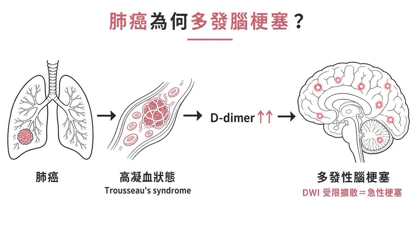 肺癌經Trousseau症候群高凝血導致多發性腦梗塞的機轉