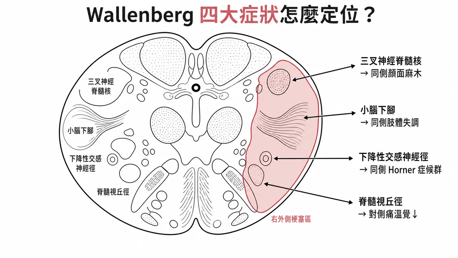 Wallenberg症候群延腦橫切面定位:四個受損結構與對應症狀