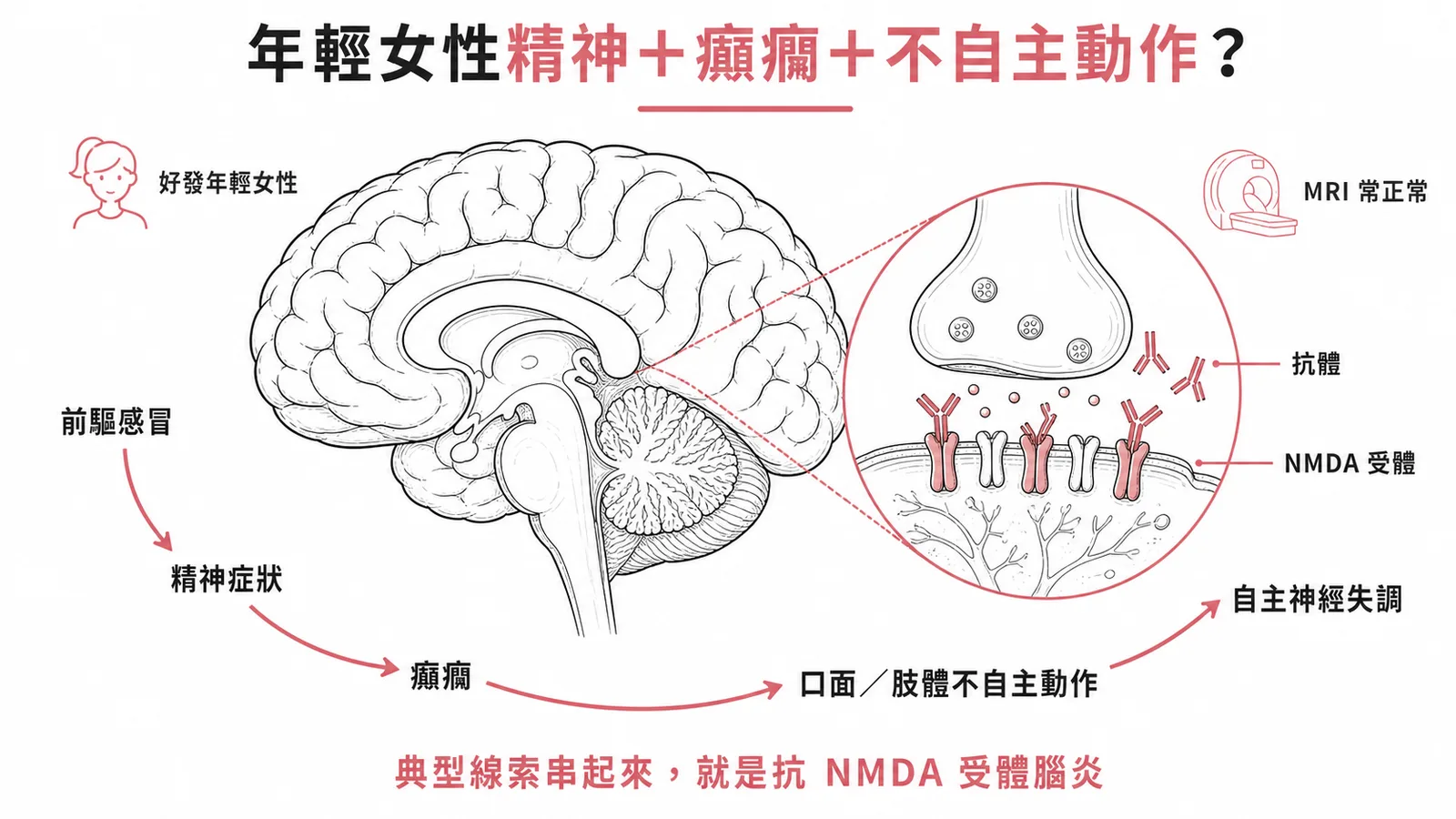 抗NMDA受體腦炎典型病程:前驅感冒到精神症狀到癲癇到不自主動作