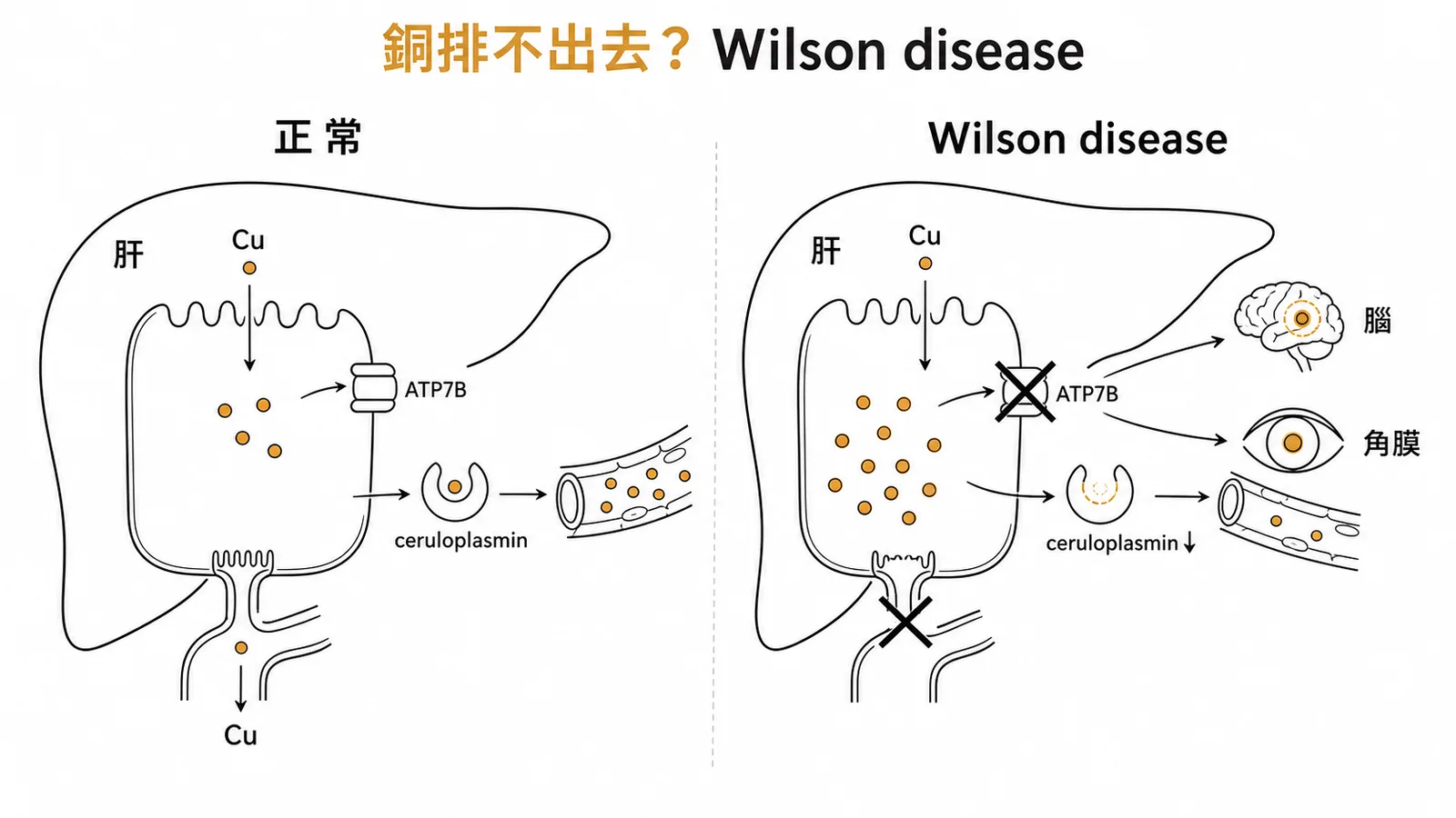 Wilson disease 銅代謝異常：ATP7B突變導致銅無法排出，ceruloplasmin降低