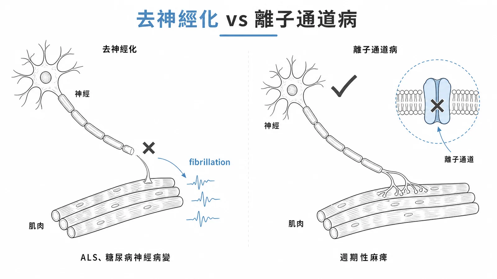 去神經化 vs 離子通道病:fibrillation只出現在神經受損,週期性麻痺不會