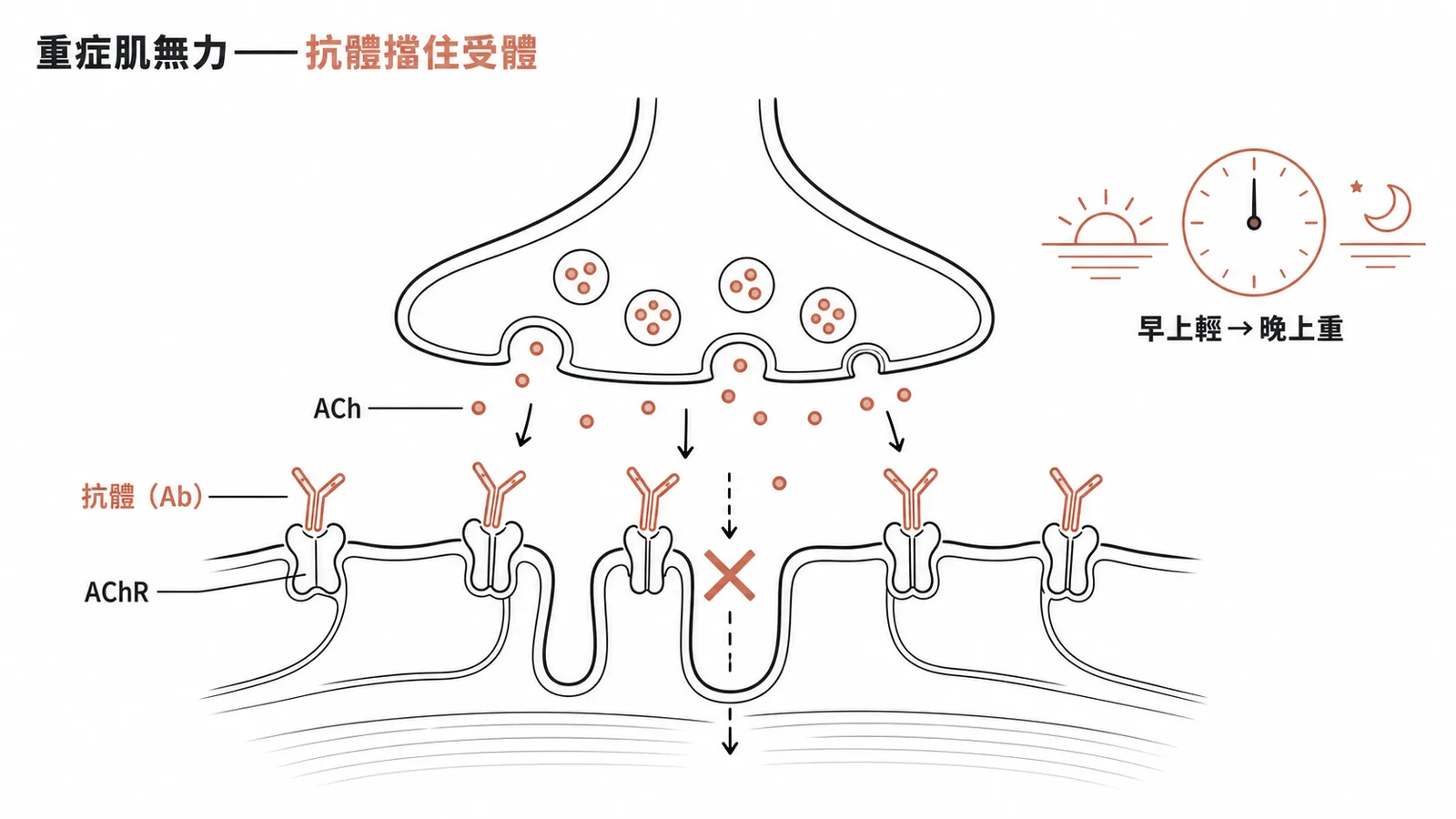 重症肌無力:自體抗體阻斷神經肌肉接合處AChR,導致波動性無力