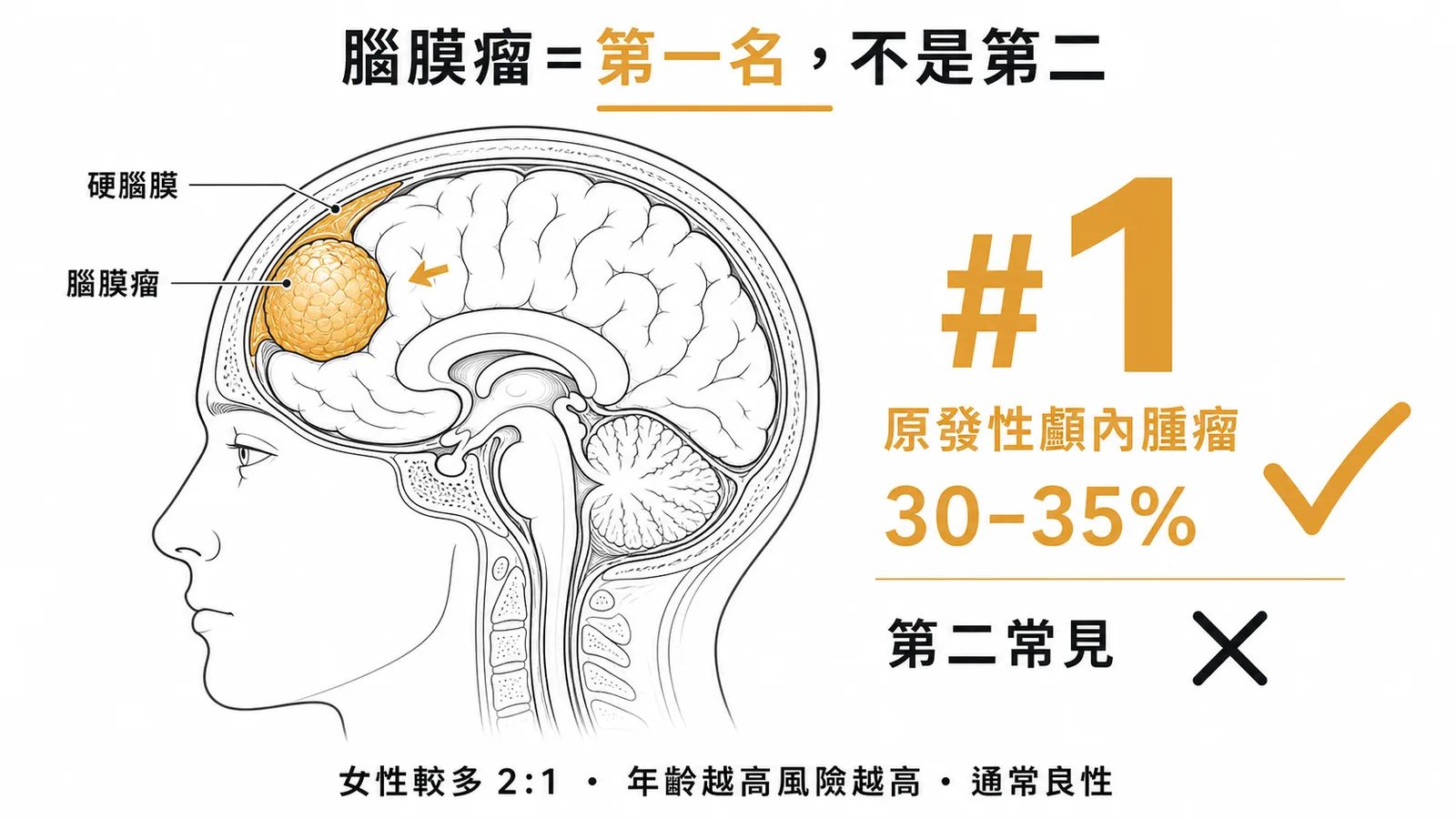 腦膜瘤是最常見的原發性顱內腫瘤,佔30-35%,不是第二常見