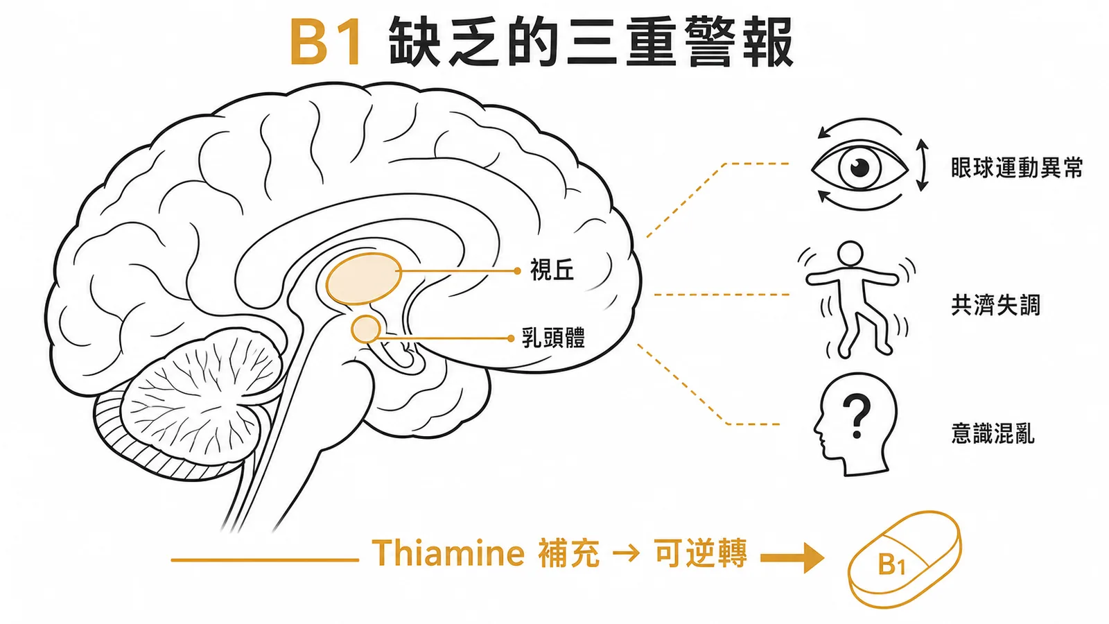 Wernicke腦病變三聯徵:眼球運動異常、共濟失調、意識混亂,由B1缺乏引起,補充thiamine可逆轉