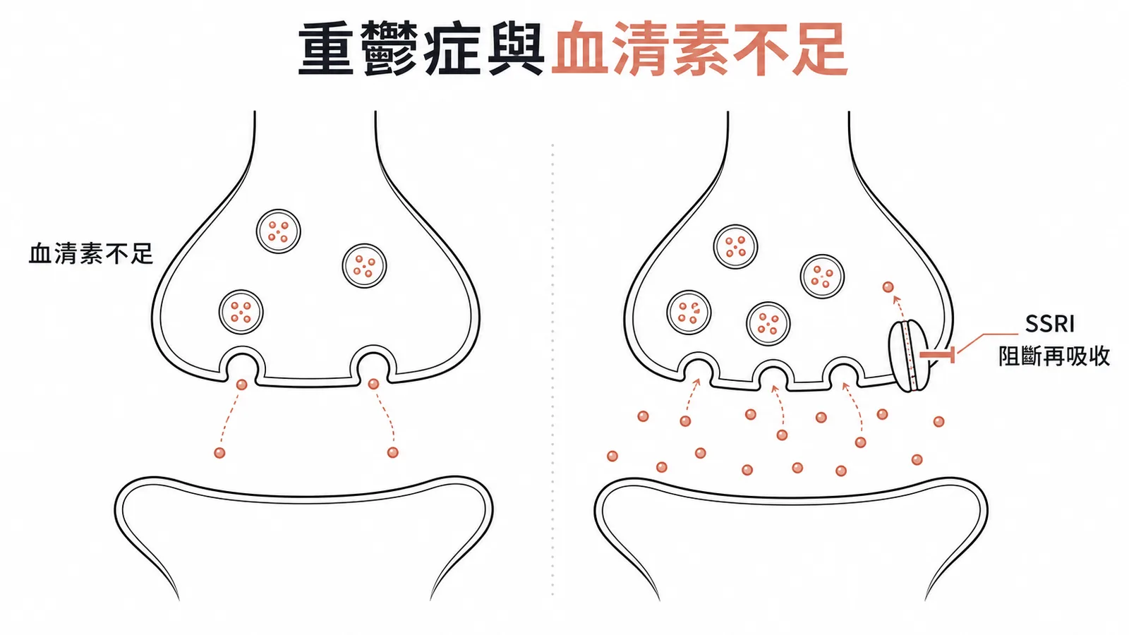 重鬱症致病機轉:突觸間血清素不足與SSRI阻斷再吸收作用示意