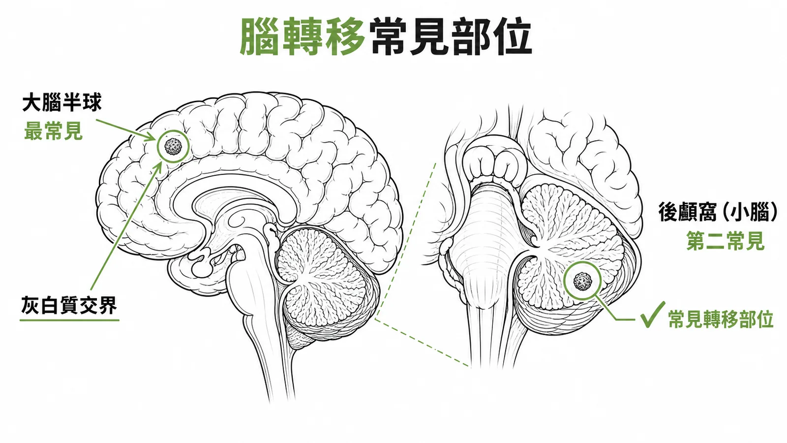 腦轉移常見部位:大腦半球灰白質交界處最常見,後顱窩小腦為第二常見