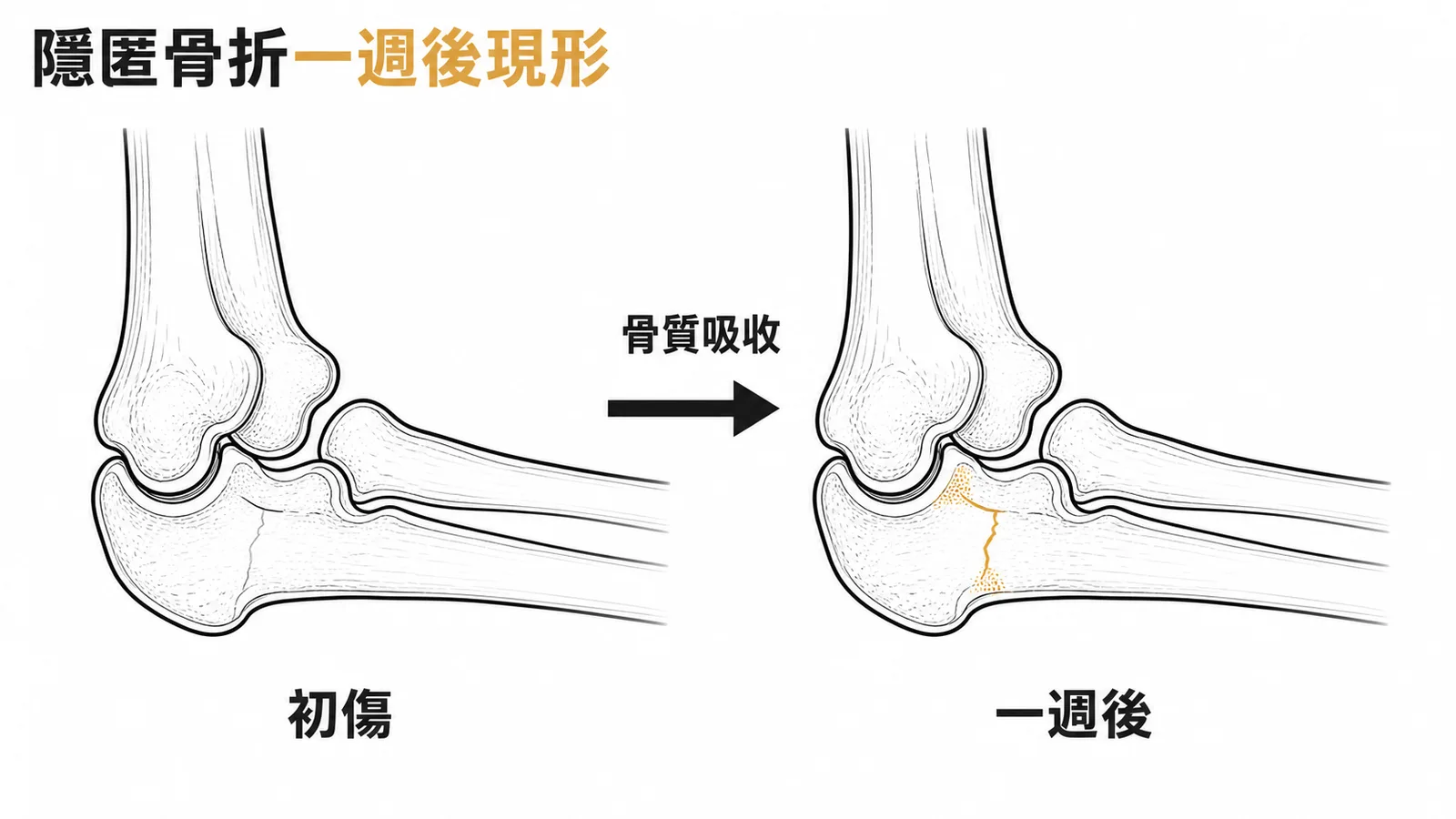 隱匿骨折一週後因骨質吸收使骨折線變清晰的前後對照