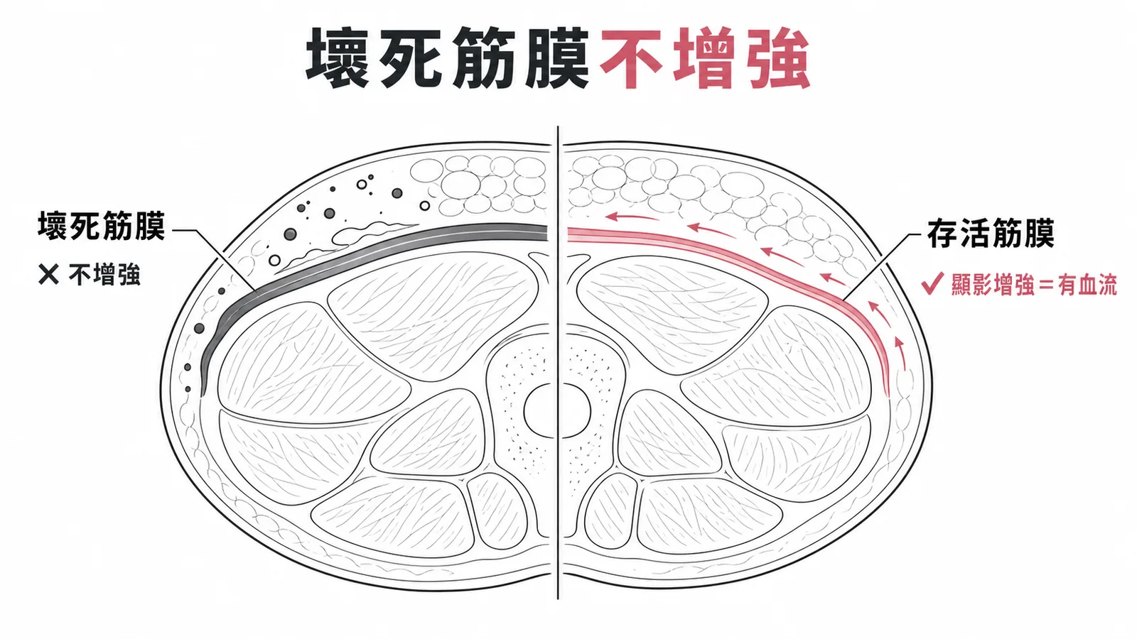 壞死筋膜不增強：壞死組織無血流不被顯影劑增強，存活筋膜有增強