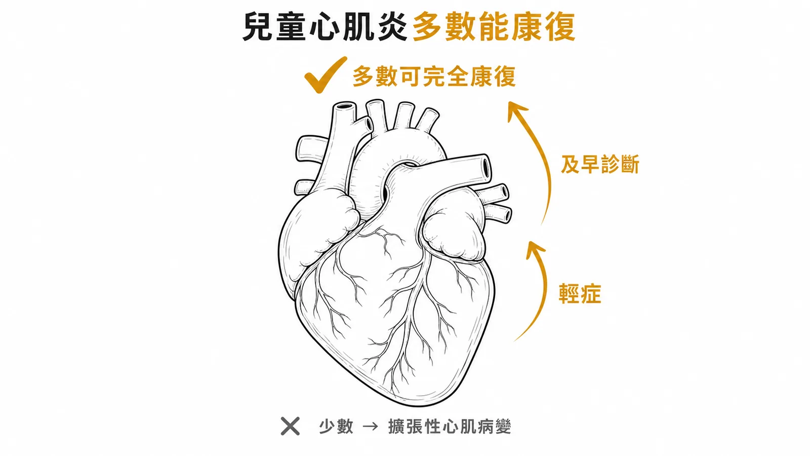 兒童心肌炎預後：多數可完全康復，少數進展為擴張性心肌病變