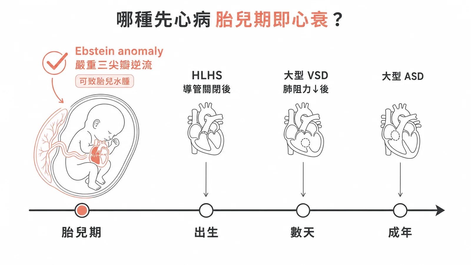 先天性心臟病心衰時機：Ebstein anomaly嚴重三尖瓣逆流可在胎兒期即導致心衰