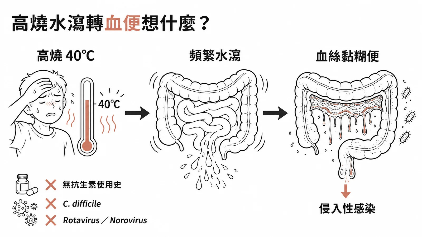 Shigella感染典型進程：高燒水瀉轉血絲黏糊便，侵入性細菌感染