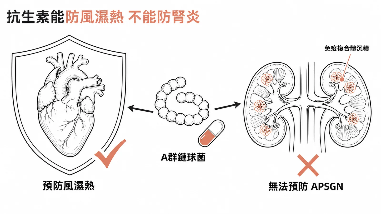 抗生素能預防風濕熱但無法預防鏈球菌感染後腎炎 APSGN