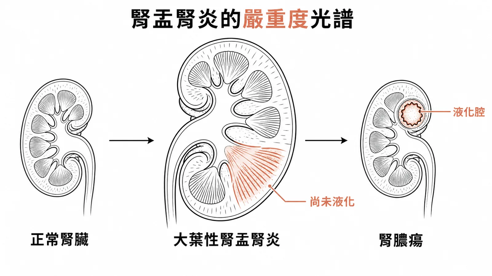 腎盂腎炎的嚴重度光譜：正常腎臟、大葉性腎盂腎炎、腎膿瘍