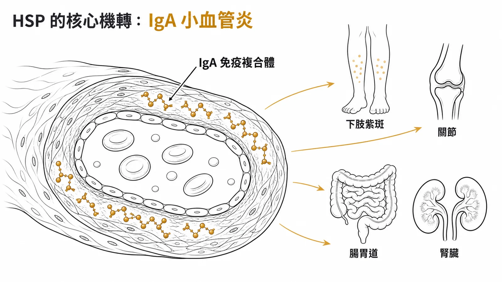 HSP 核心機轉：IgA 免疫複合體沉積於小血管壁引起四大表現