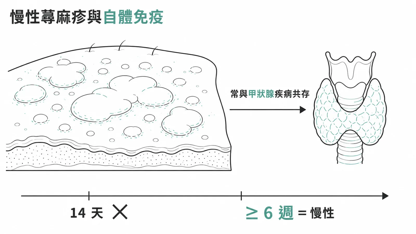 慢性蕁麻疹與自體免疫疾病相關，定義為 6 週以上反覆發作