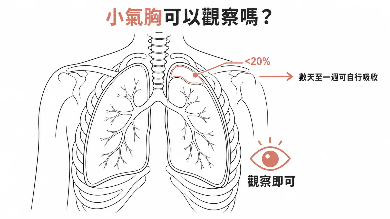 小於20%氣胸可觀察等待自行吸收