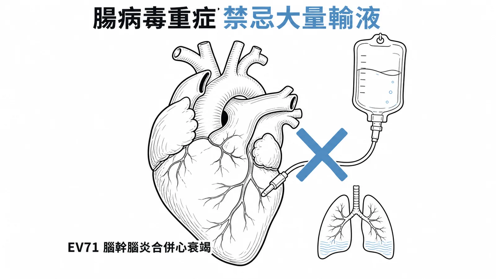 腸病毒EV71重症合併心衰竭時禁忌快速大量輸液