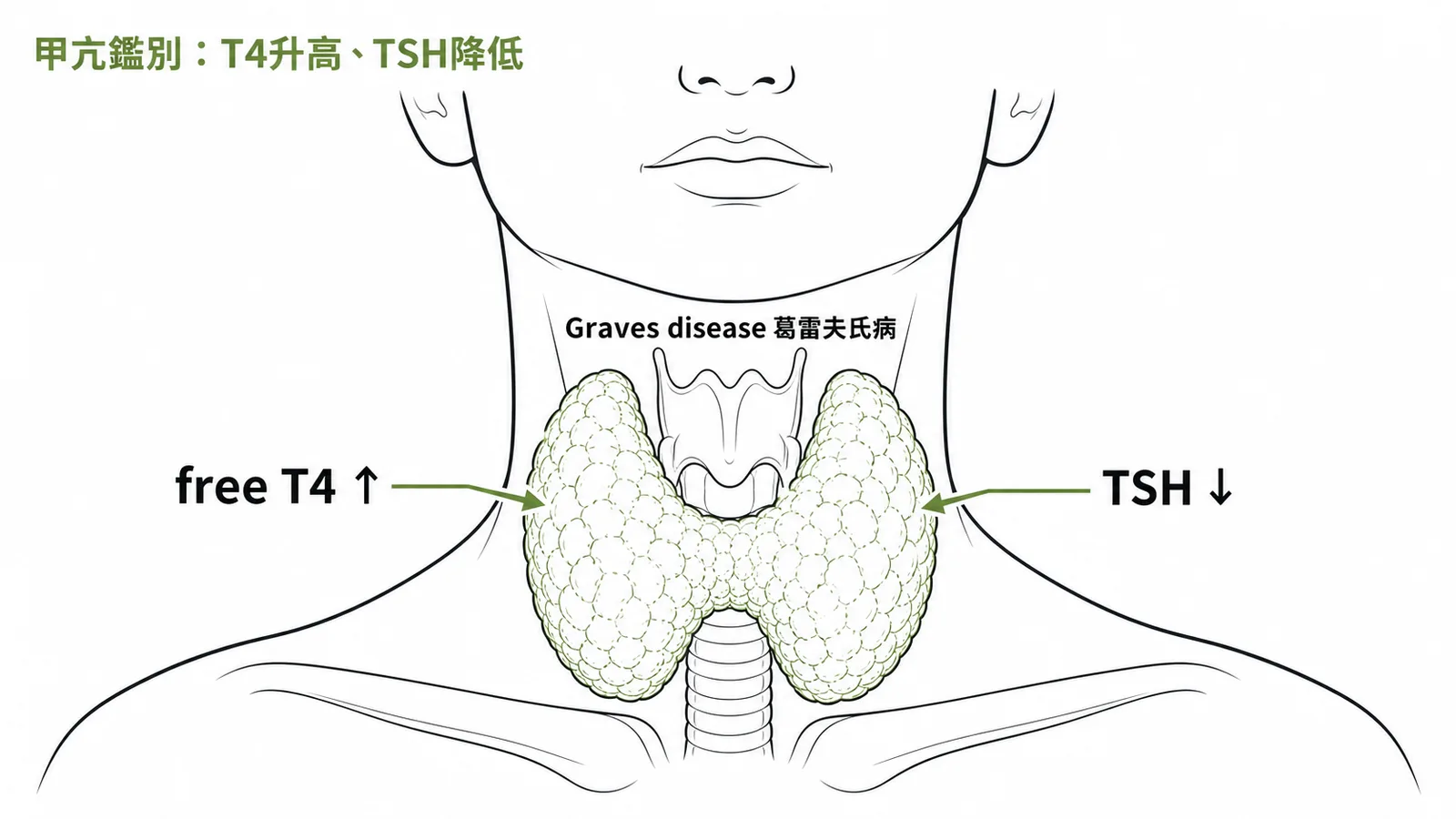Graves disease甲亢鑑別：free T4升高加TSH降低與雙側甲狀腺腫大