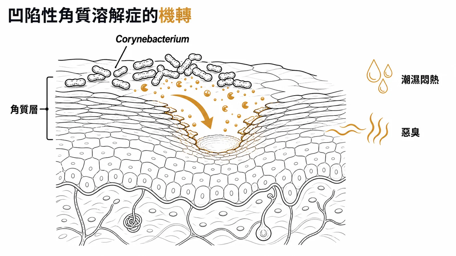 凹陷性角質溶解症機轉：Corynebacterium 在潮濕環境分解角質形成凹陷與惡臭