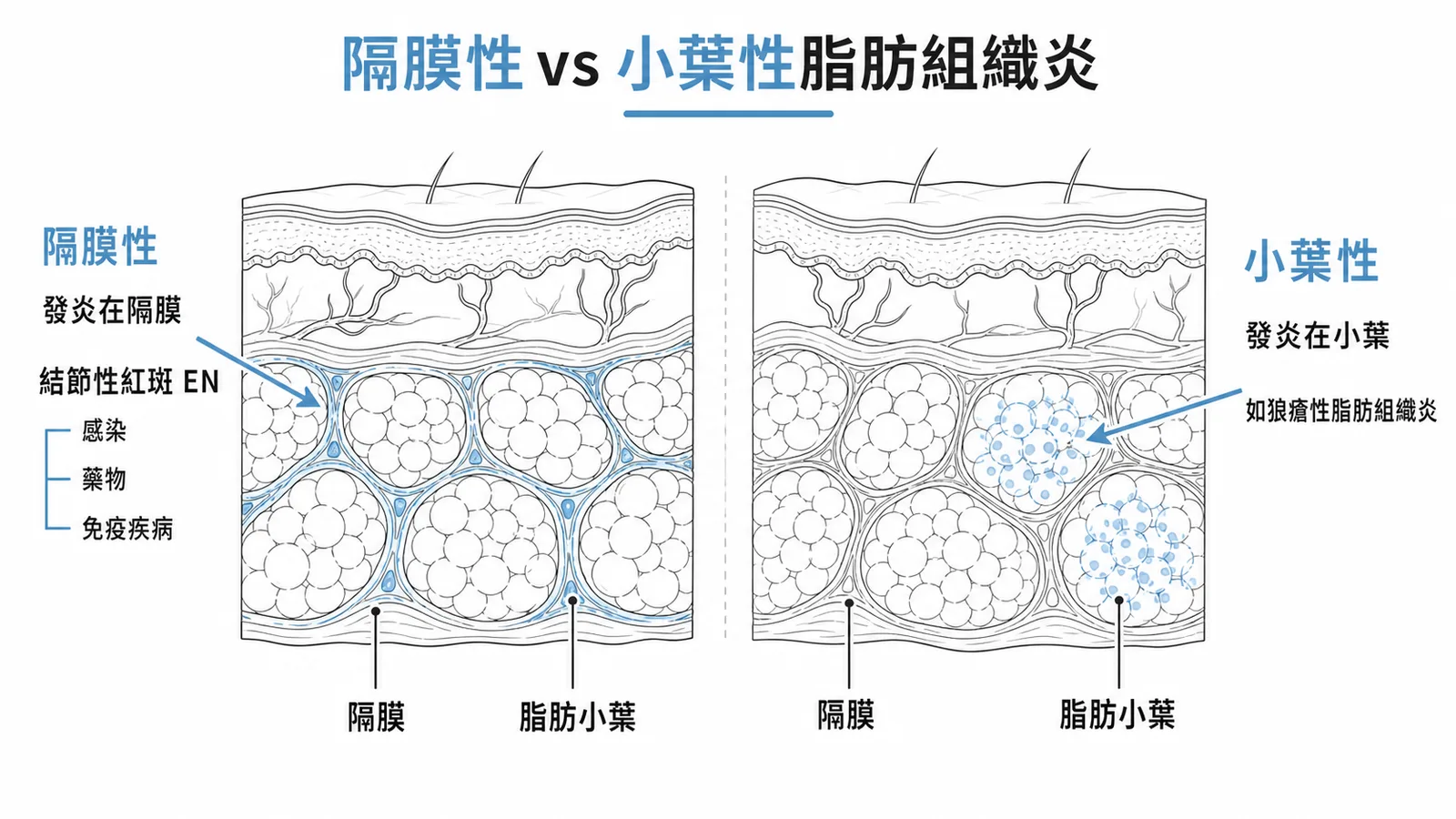 隔膜性 vs 小葉性脂肪組織炎：隔膜性以結節性紅斑為代表，小葉性以狼瘡脂肪組織炎為代表