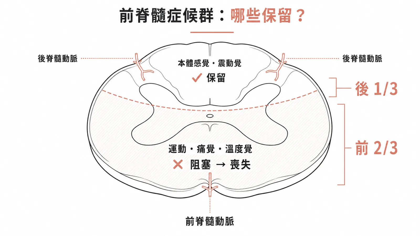 脊髓橫切面血供分區:前脊髓動脈供前2/3(運動、痛溫覺喪失),後脊髓動脈供後1/3(本體感覺保留)